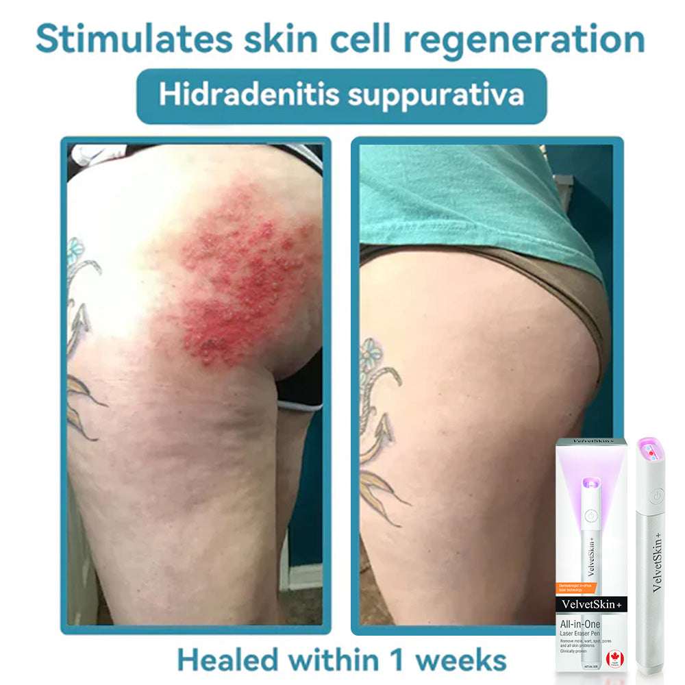 💯QIAWI™ All-in-One CO₂ Laser Eraser Pen | Removes Moles, Warts, Skin Flaws & Pigmentation